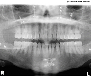 Marie-Hélène Cyr - Panoramic X-ray after the orthodontic treatments (February 10, 2009)